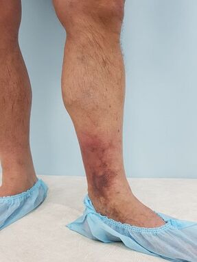 complicaciones de las venas varicosas en los hombres