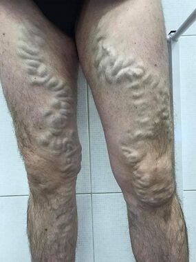 venas varicosas masculinas desatendidas