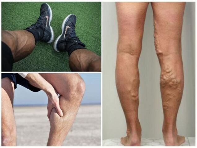 ¿Cómo se ven las venas varicosas en las piernas de los hombres