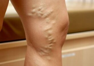 Venas varicosas en las piernas de una mujer. 