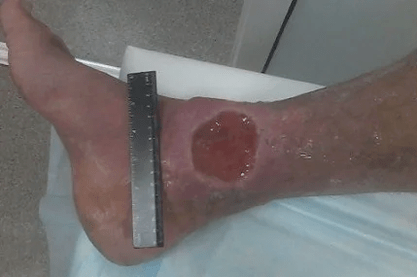 Complicaciones de la venas varicosas