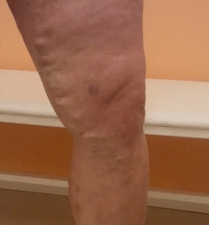 varices