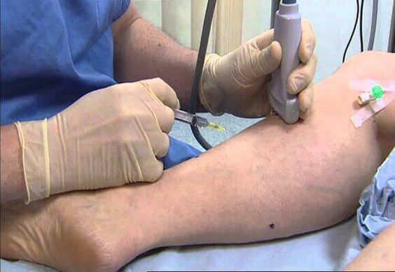 Varices