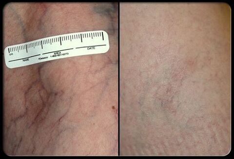 Antes y después del procedimiento de terapia con láser