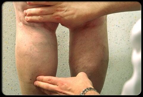 El médico examina las piernas con venas varicosas