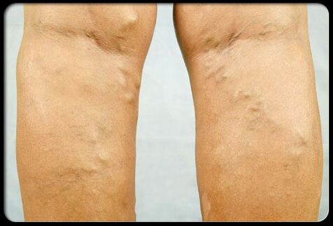 Venas varicosas en las piernas